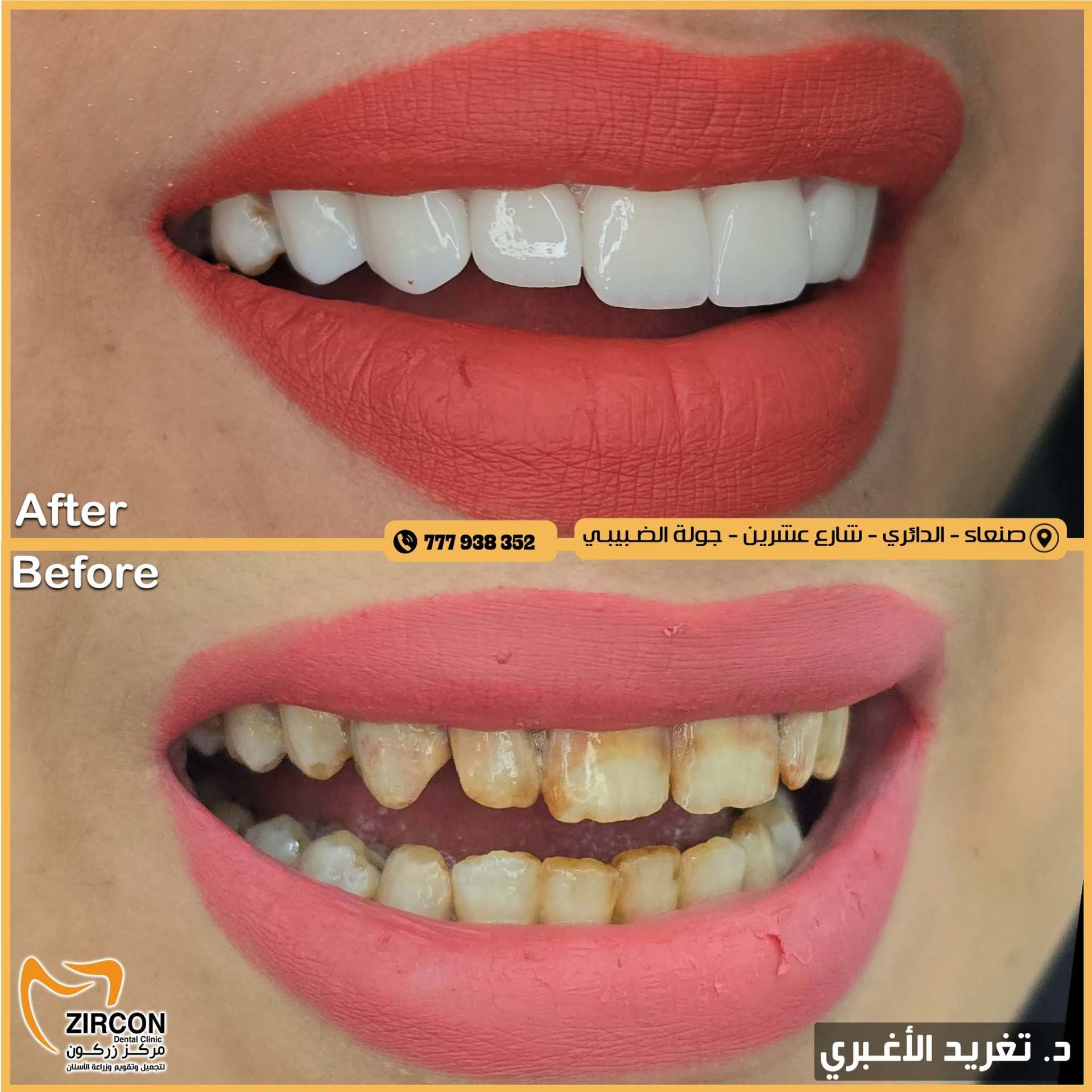 حالة قبل وبعد 2 - مركز زركون
