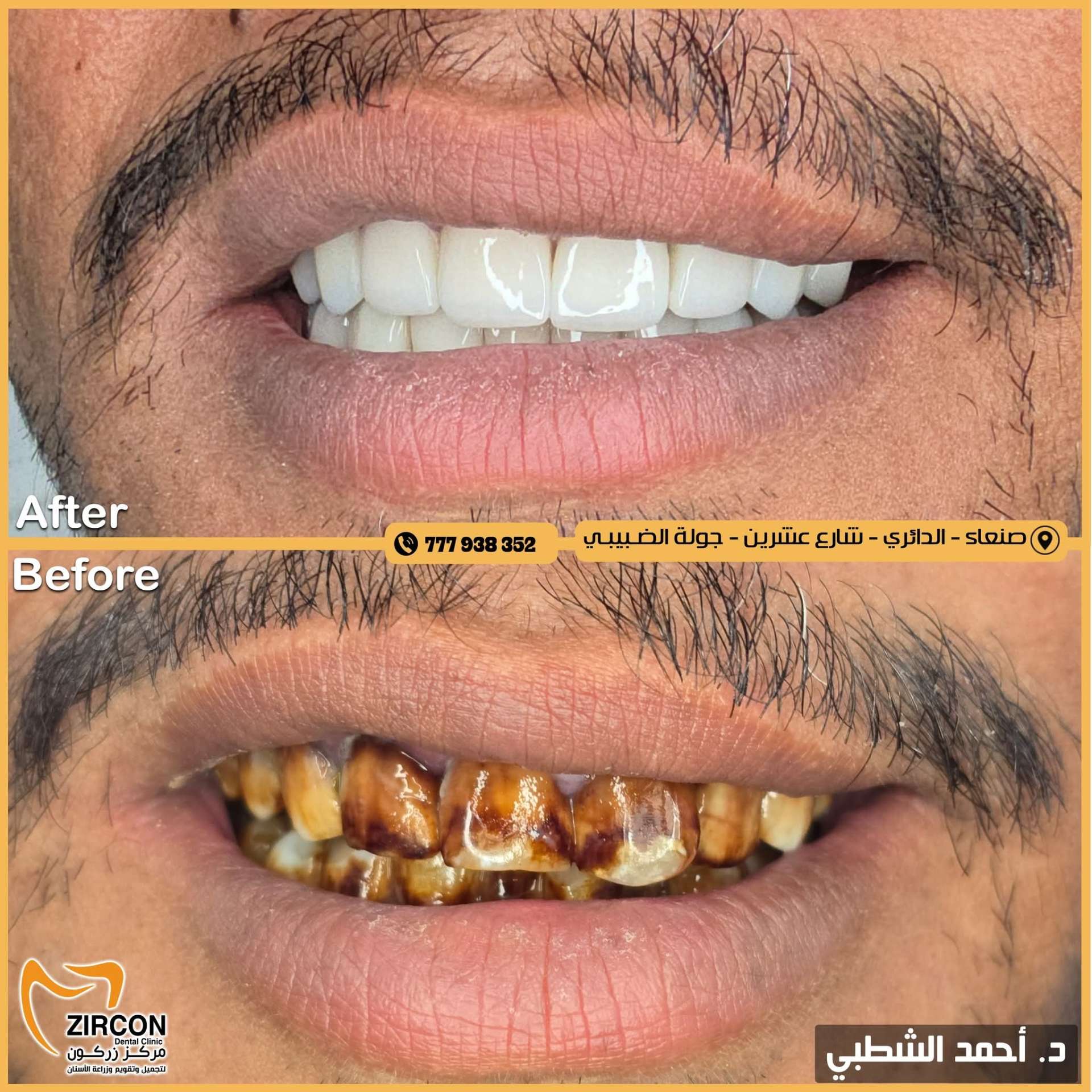 حالة قبل وبعد 3 - مركز زركون