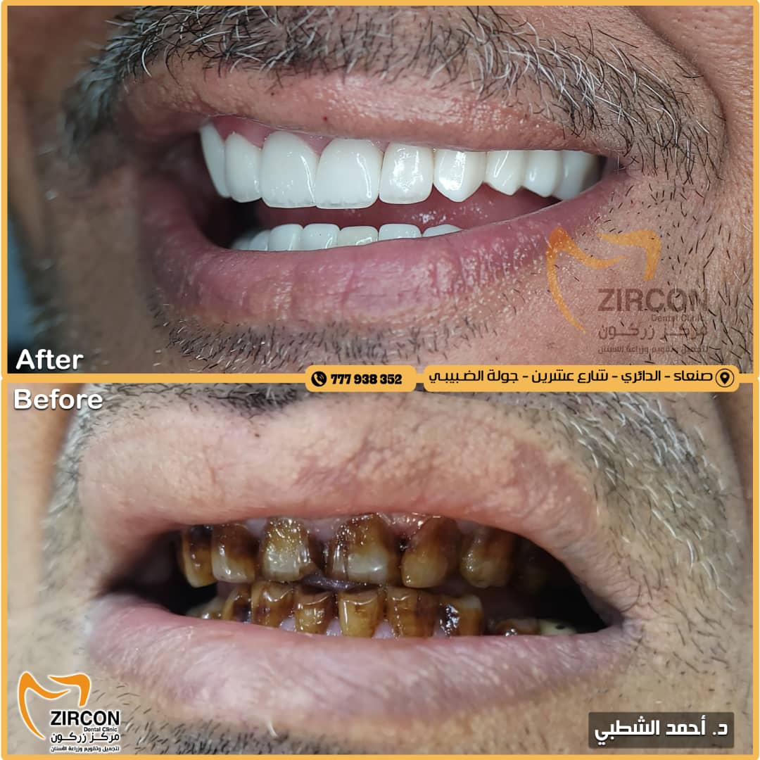 حالة قبل وبعد 5 - مركز زركون