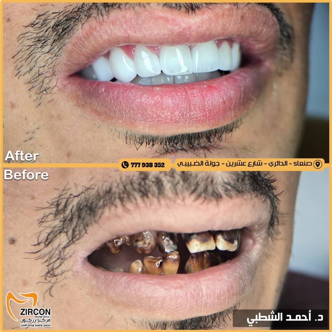 حالة قبل وبعد 6 - مركز زركون