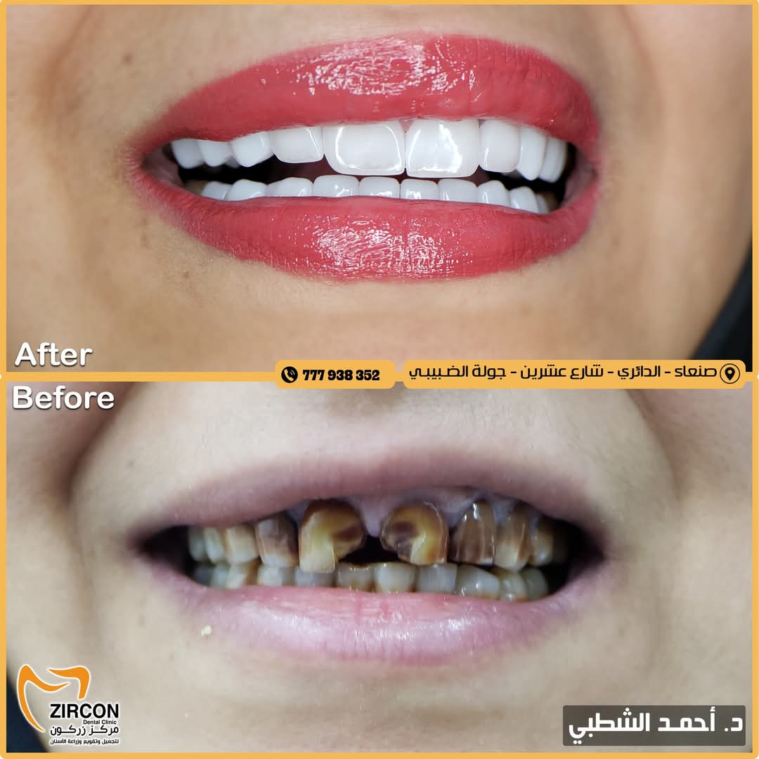 حالة قبل وبعد 9 - مركز زركون